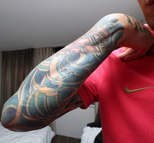 张琳芃展示被抠出的血痕手臂