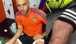 巴萨怒斥对手小题大做 抓痕发照片太矫情