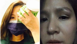 艺人吴怡霈跑步撞脸 网晒受伤近照