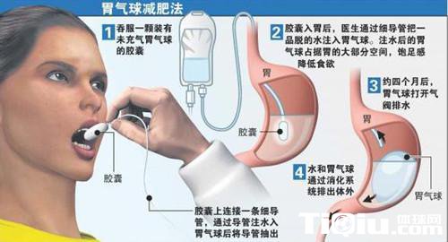 新减肥法不必动手术 吞气球让食欲大减