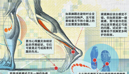 跑步导致脚疾日益严重 专家五点建议阐述病因